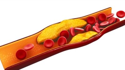 علامات في عينيك تدّل أنّ مستوى الكوليتسرول بدمك خطير!