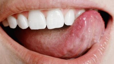ثلاث علامات للسرطان قد تظهر على اللسان