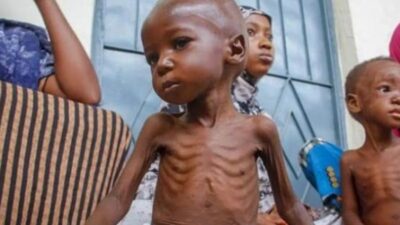 أكثر من نصف مليون طفل في الصومال يواجهون سوء التغذية